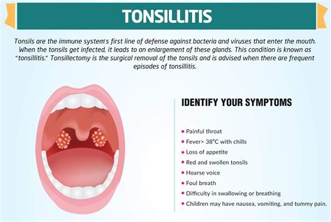 Yellow Spots On Tonsils