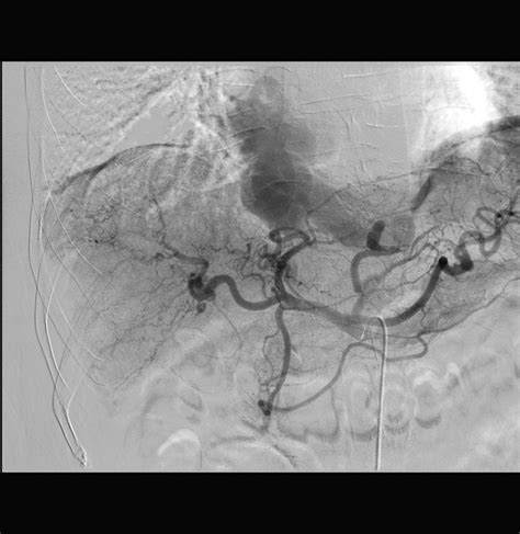 The Pump and the Tubes: Right Gastric Artery