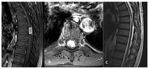 Medicina | Free Full-Text | Spinal Meningioma Surgery in Octogenarians ...