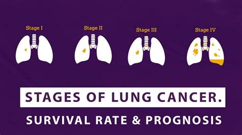 Stages Of Lung Cancer – Survival Rate And Prognosis - Macs Clinic