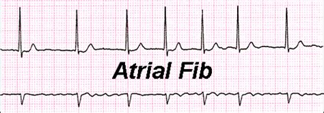 Atrial Flutter and Atrial Fibrillation Nursing Notes - Straight A Nursing