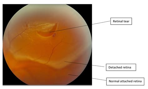 Retinal Detachment | Ophthalmology | Geeky Medics