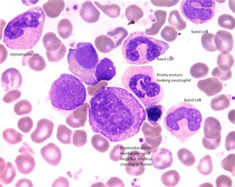 Promyelocytes And Myelocytes Related Med Lab, Lab Tech, Ascp, Mcat ...