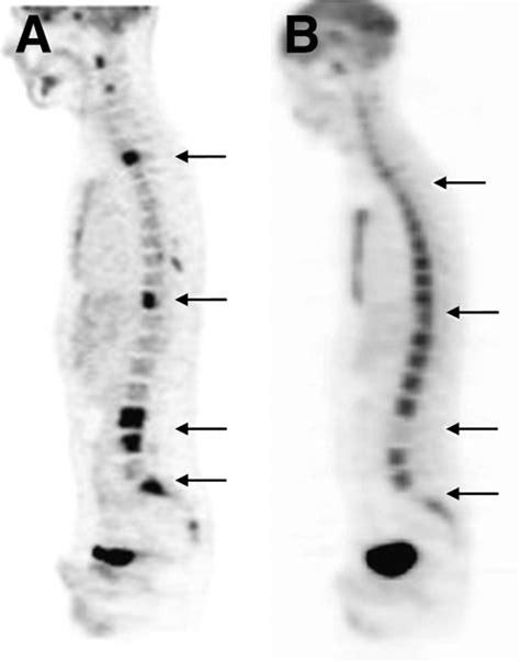 Lymphoma: Pet Scan Lymphoma