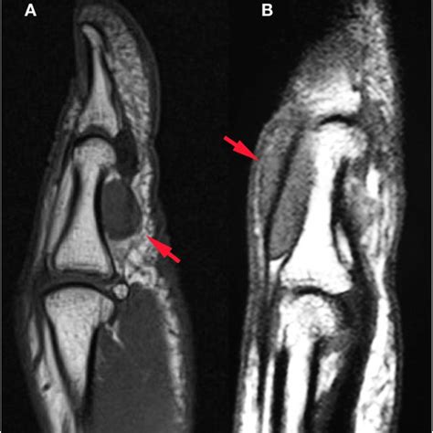 MRI may reveal GCTTS proximity to DIP (a) and PIP (b) joints | Download ...