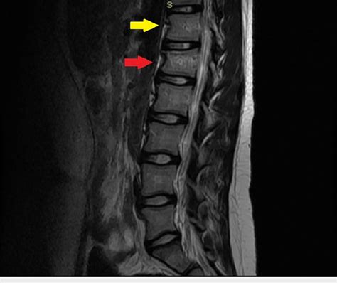 T2 sagittal MR image of the lumbar spine. Wedge fracture of the T12 ...