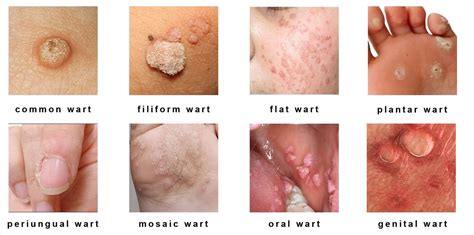 types-of-warts - Health Vision