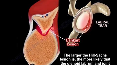 LESION DE BANKART Y HILL SACHS PDF