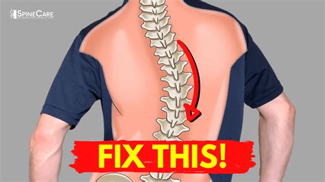 How to Relieve Your Scoliosis Back Pain in 30 SECONDS | SpineCare