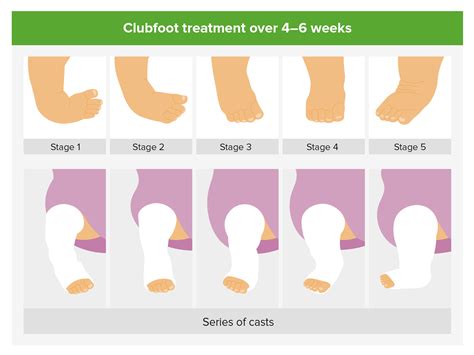 Metatarsus Adductus Vs Clubfoot