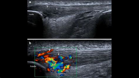 Tendon and Ligament Ultrasound - Internet Book Of MSK Ultrasound