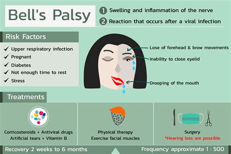 Bell's Palsy | Eye Patient