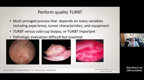 Optimizing Bladder Cancer Treatment During the BCG Shortage Era