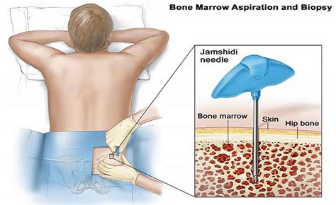 Bone Marrow Biopsy - Reasons, Pain, Complications