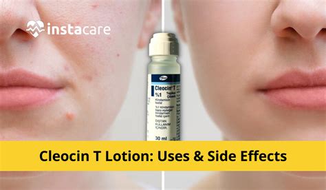 Cleocin T Lotion - Uses Side Effects and Price in Pakistan