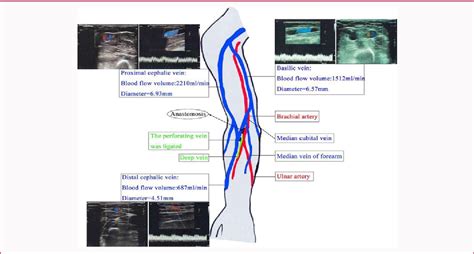 Figure 1 from Modified Non-Transposed Brachiobasilic Fistula is a Good ...