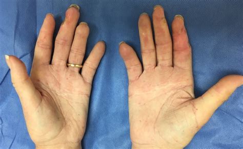 SYSTEMIC SCLEROSIS / SCLERODERMA (CREST) | Hand Surgery Source