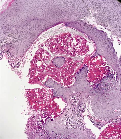 Molluscum Contagiosum Pathology