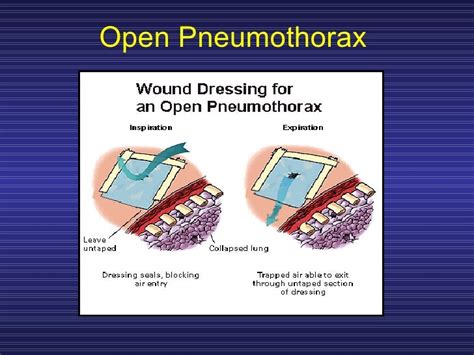 Treating Penetrating Chest Trauma