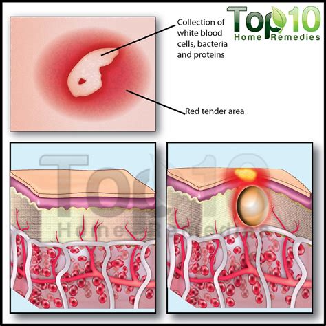 Home Remedies for Boils and Abscesses | Top 10 Home Remedies