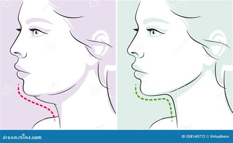 Woman Profile Double Chin before after Vector Illustration Stock Vector ...