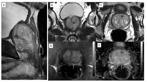 [Figure, MRI Prostate: PIRADS- 2; A:...] - StatPearls - NCBI Bookshelf