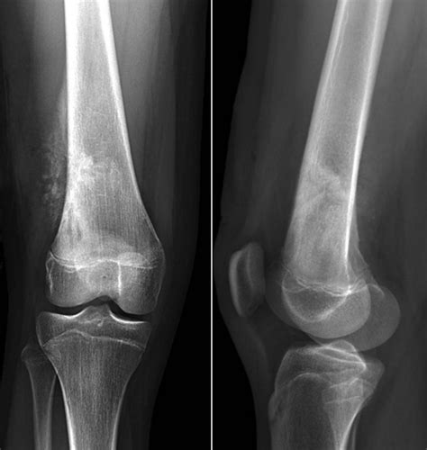 Patofisiologi Osteosarcoma