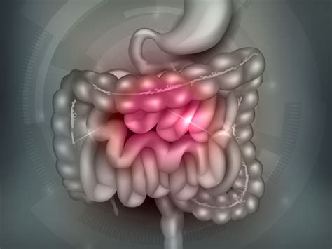 Ileocecal Valve Syndrome - Ask Dr. Maxwell