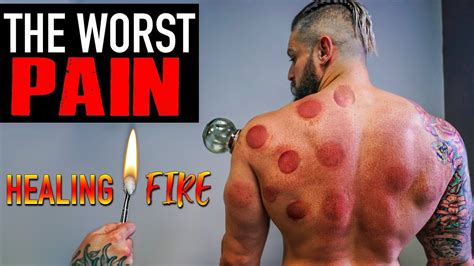 The WORST PAIN - Can FIRE CUPPING / Hijama Fix Muscle Injury?? (Lex ...