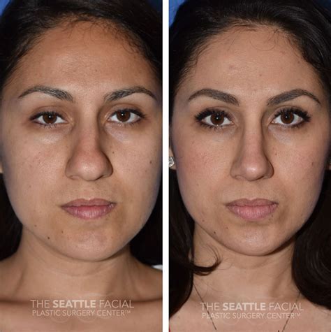 Rhinoplasty Before And After Bulbous Tip