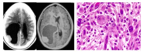 Pathology Outlines - Pleomorphic xanthoastrocytoma