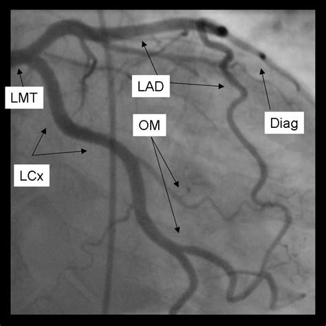 63 HEART TEST CATHETERIZATION - TestHeart