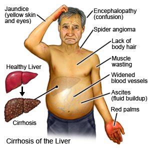 Liver Pain Symptoms Location