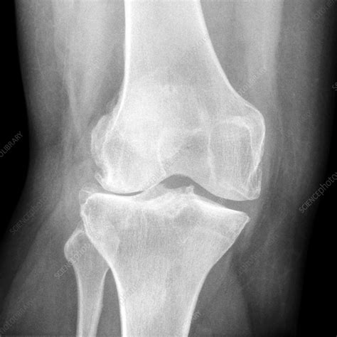 Knee in osteoarthritis, X-ray - Stock Image - C030/2153 - Science Photo ...