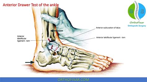 Anterior Drawer Test