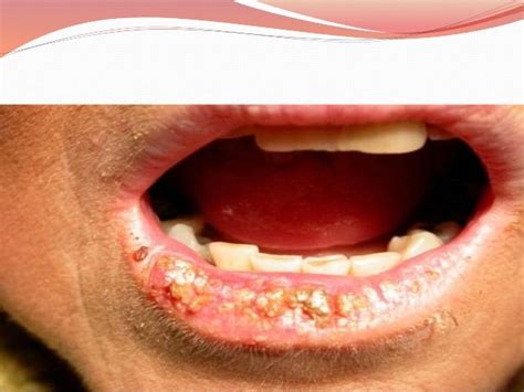 Lip Diseases Images | Ownerlip.co