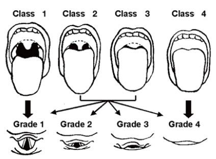 Mallampati score. Class 1: full visibility of tonsils, uvula, and soft ...