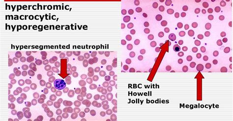 Macrocytic Anemia - Causes, Symptoms & Macrocytic Anemia Treatment