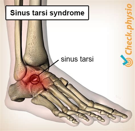 Sinus tarsi syndrome | Physio Check