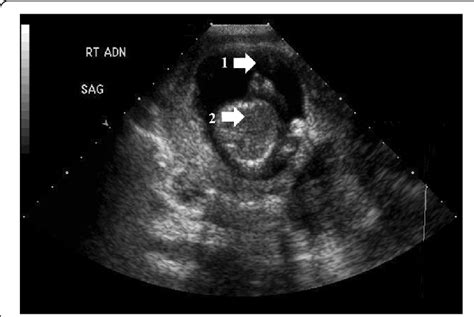 Ultrasound of abdomen and pelvis. 1 Gestational sac. 2 Fetus ...