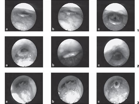 Figure 1 from Effectiveness of the Jaw-Thrust Maneuver in Opening the ...