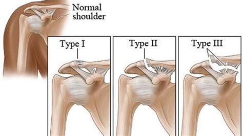 AC Joint Separation - Carolina Regional Orthopedics