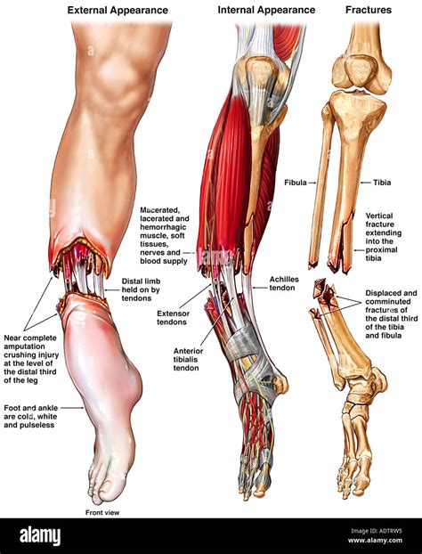 Traumatic Leg Amputation