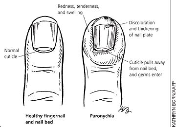 Chronic Paronychia: What You Should Know | AAFP