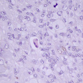 Characteristic histology of the GCTTS lesions: colagenized stroma ...