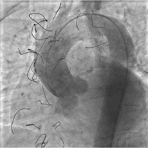 Figure 1 from Broken and scattered sternal wires. | Semantic Scholar