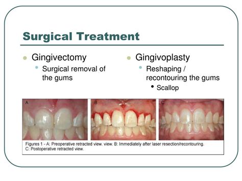 PPT - Periodontics PowerPoint Presentation, free download - ID:3945306