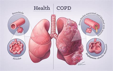 Chronic Obstructive Pulmonary Disease Copd