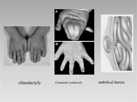 What is Aarskog-Scott Syndrome? - PT Master Guide