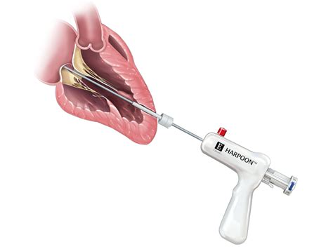 Edwards Lifesciences launches pivotal trial of mitral valve repair ...